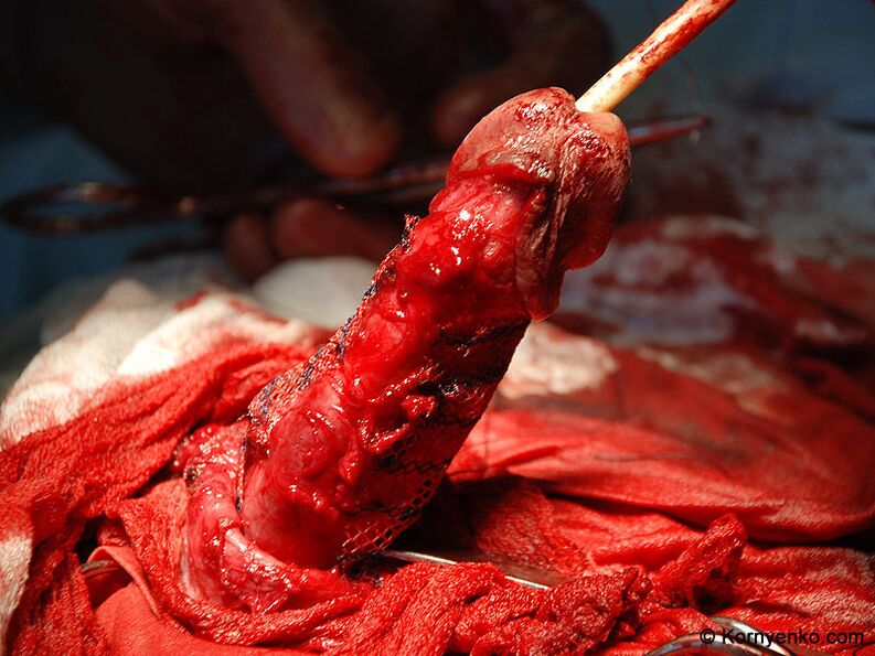 installation of collagen matrix for penis enlargement