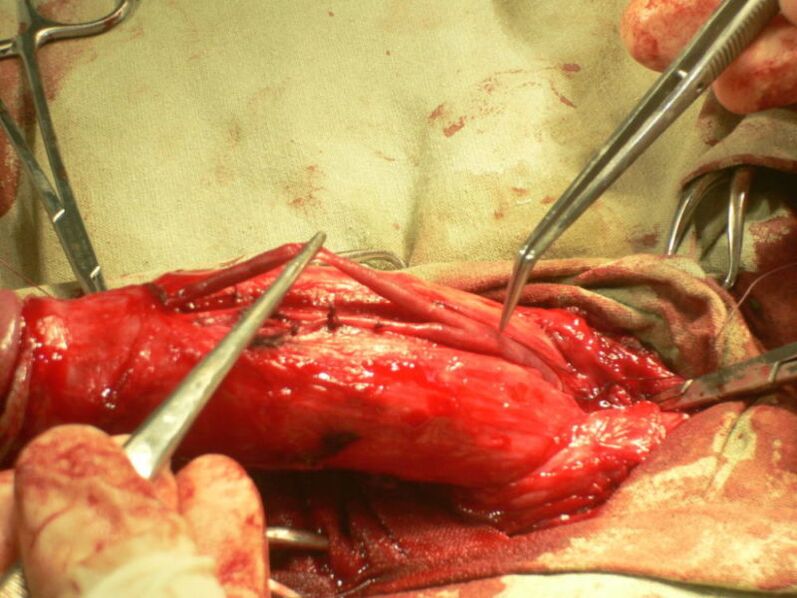 lipofilling of the penis to enlarge