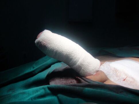 bandaged penis after enlargement operation