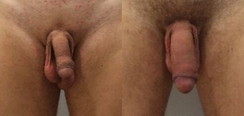 before and after penis enlargement surgery