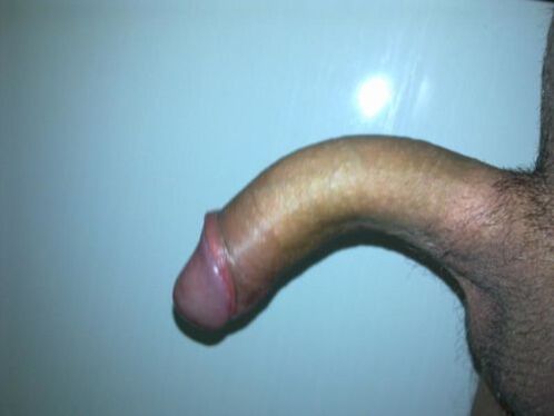 curvature of the penis after enlargement surgery