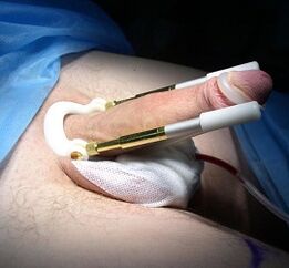 How penis enlargement surgery is done